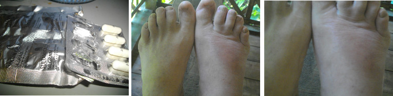 Images of foot with Cellulitis