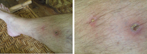 Image of infected leg healing