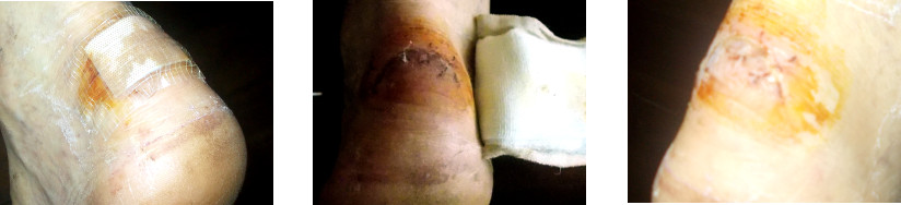 Images of wounded heel healing
