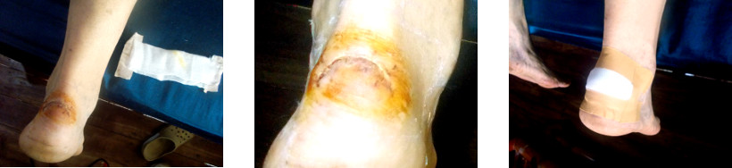 Images of wounded heel healing
