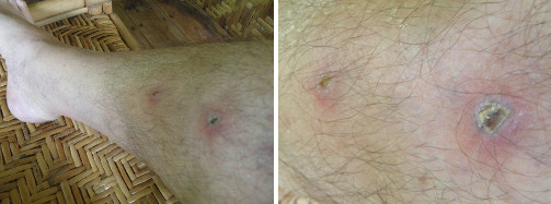 Image of infected leg healing -day 16