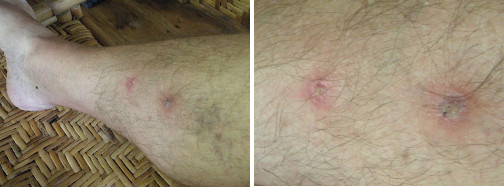 Images of infected leg healing -day 17