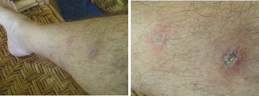 Images of leg healing -day 18