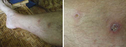 Images of infected leg healing