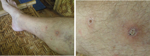 Images of infected leg healing