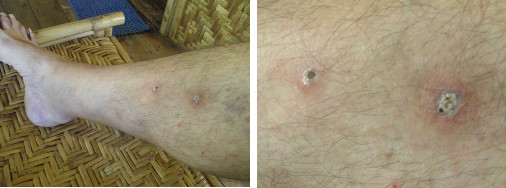 Images of infected leg healing