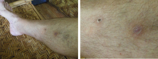 Images of infected leg healing