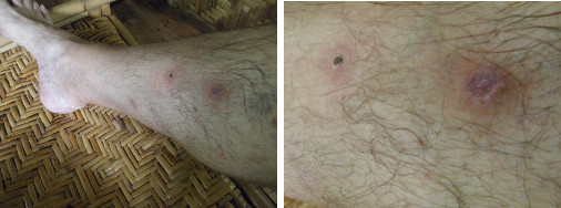 Images of infected leg healing