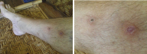 Images of infected leg healing