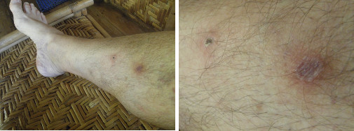 Images of infected leg healing