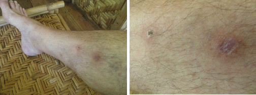 Images of infected leg healing