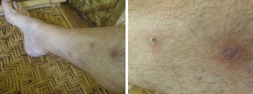 Images of infected leg healing