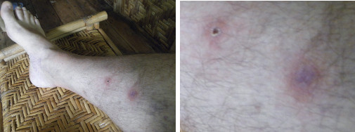 Images of infected leg healing