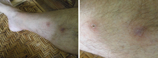 Images of infected leg healing