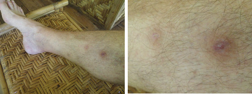Images of infected leg healing