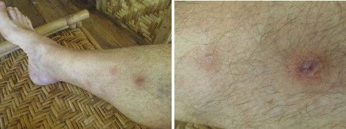 Images of infected leg healing