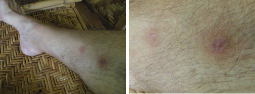 Images of infected leg healing