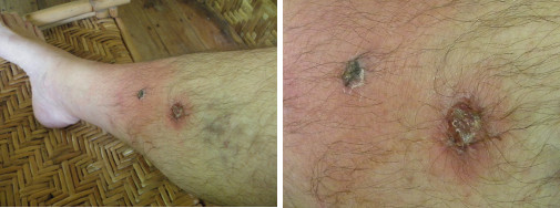 Images of infected boils on leg -day
        1