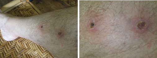 Images of infected leg healing after taking anti-biotic
        -day 10
