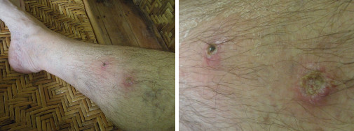 Images of infected leg healing after anti-biotocs