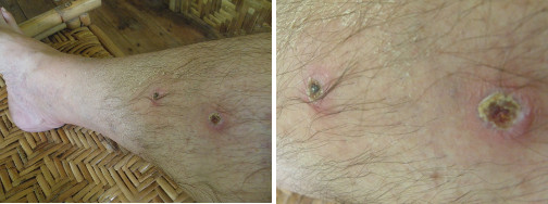 Images of infected leg healing -day 13