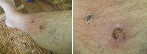 Images of infected boils on leg -day
        2