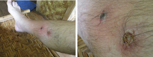 Images of infected boils on leg -day
        3