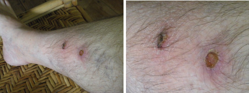 Images of infected leg being treated with anti-biotic
        -day 5