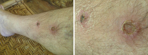 Images of infected leg healing after anti-biotic
          treatment -day 5