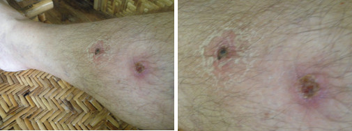 Images of leg healing after taking anti-biotic -day 7