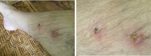 Images of infected leg healing after taking anti-biotics
        -day 8