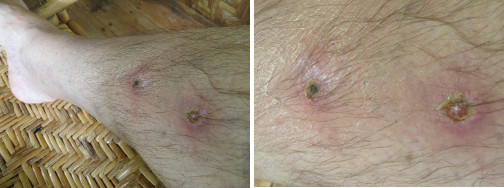 Images of infected leg healing after taking anti-biotic
        -day 9