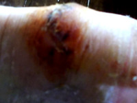 Imagws of wounded heel